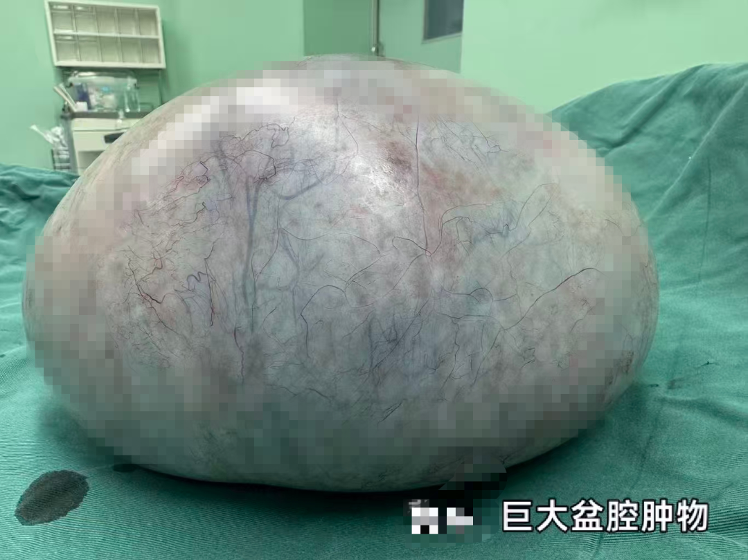 七年肿物缠身叠加高危肺病史!国文医院妇科与多学科协作成功救治高危巨大盆腔肿瘤患者