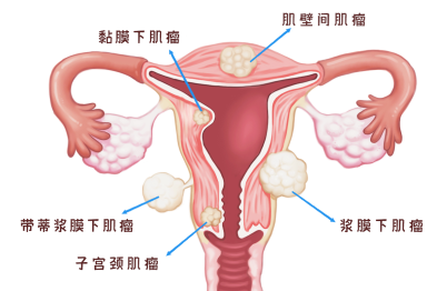 子宫肌瘤分型科普