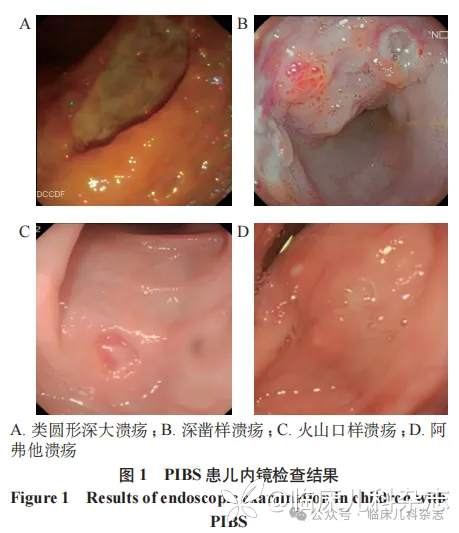 儿童肠型贝赫切特综合征 13 例病例系列分析