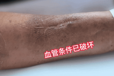 肾内医生通过吸脂术，让肾病患者造瘘有了新选择