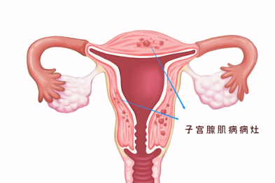 聚焦超声消融手术治疗子宫腺肌病的现状及展望