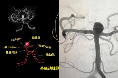 精准微创 「拆弹」！国文医院卒中中心成功救治高龄高危基底动脉瘤患者