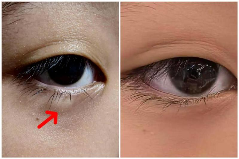 孩子眼皮长了「小肿块」只能手术吗?深圳南山华厦眼科医院 OptiLight 强脉冲光提供更温和的选择