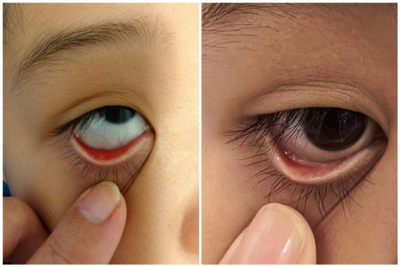 孩子眼皮长了「小肿块」只能手术吗?深圳南山华厦眼科医院 OptiLight 强脉冲光提供更温和的选择