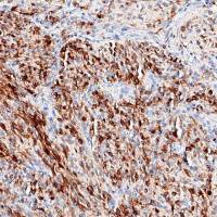 中杉金桥  ZA-0643  EGFR v Ⅲ抗体试剂（免疫组织化学）