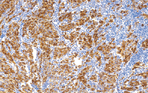 鼠抗人黑色素瘤标记物单克隆抗体  TDCMM-0150