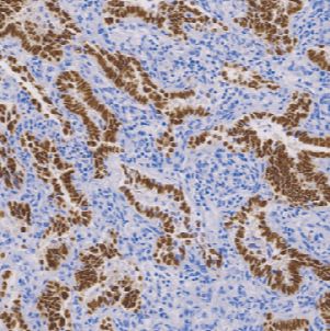 鼠抗人甲状腺转录因子（TTF-1）单克隆抗体  TDCTM-0263