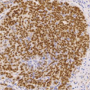 鼠抗人肾母细胞瘤单克隆抗体  TDCWM-0011