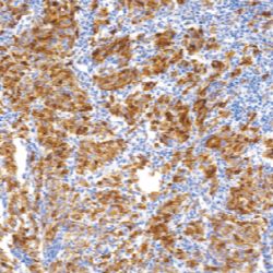 鼠抗人黑色素瘤标记物单克隆抗体  TDCMM-0150