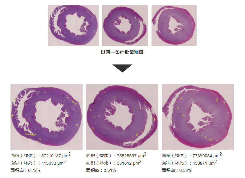 纤维化的定量化