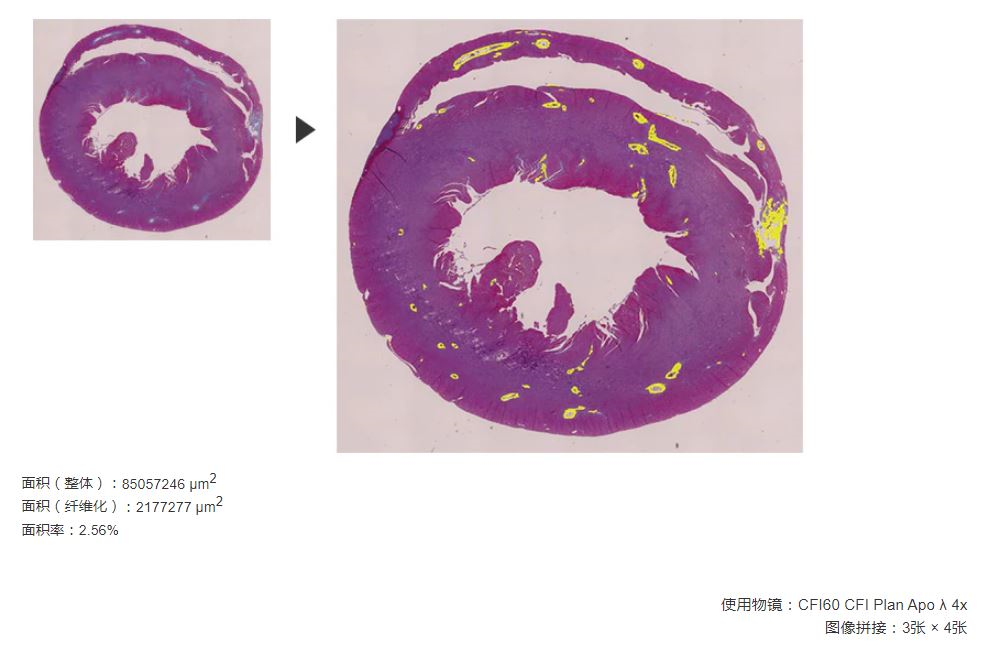 纤维化的定量化