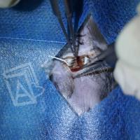 【免费检测超声】主动脉弓缩窄tac模型