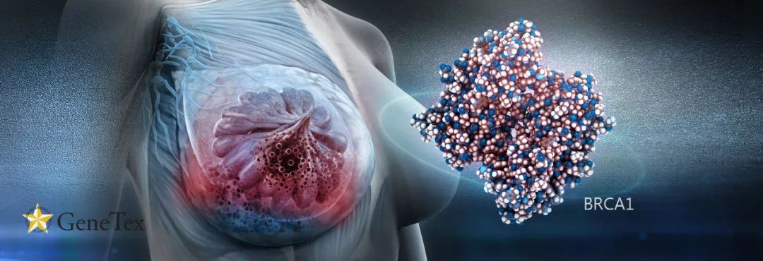 BRCA1遗传性乳腺癌与上皮组织基质细胞癌前病变