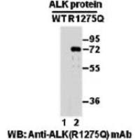 ALK(R1275Q)