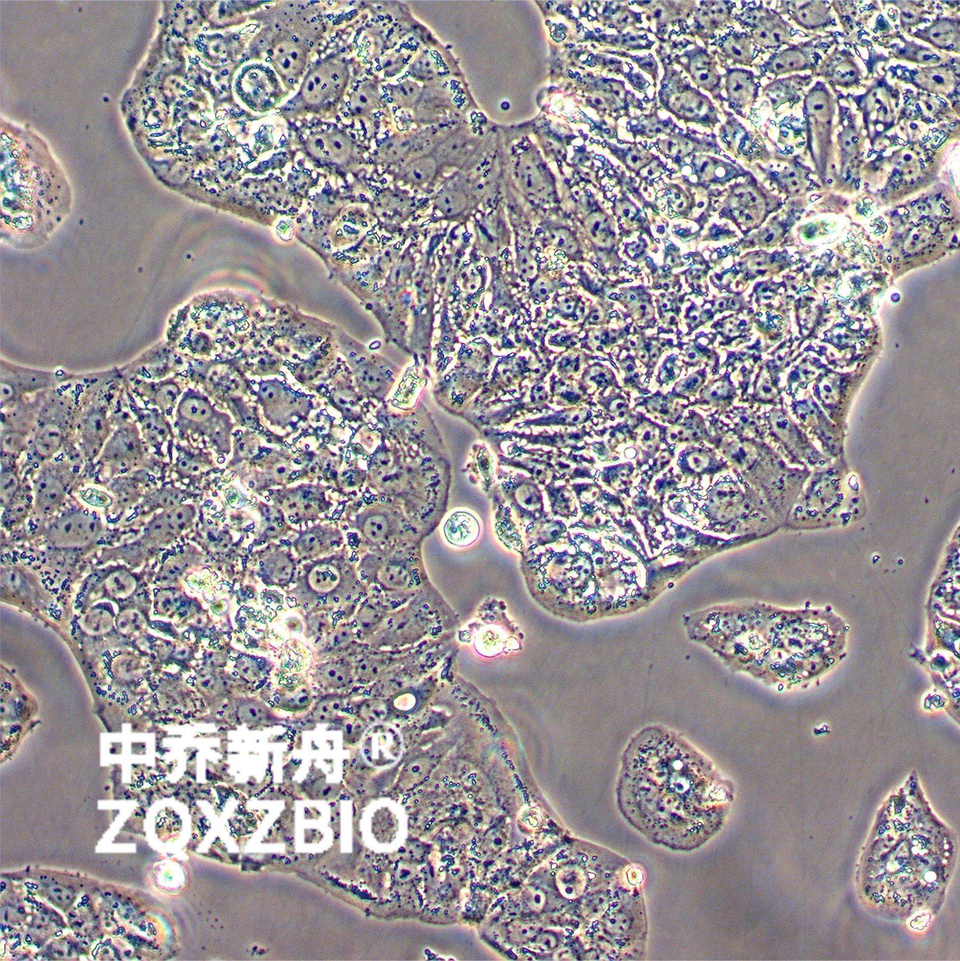 绒毛膜癌病理切片图片