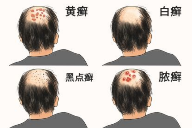 抗真菌卫士——乳铁蛋白