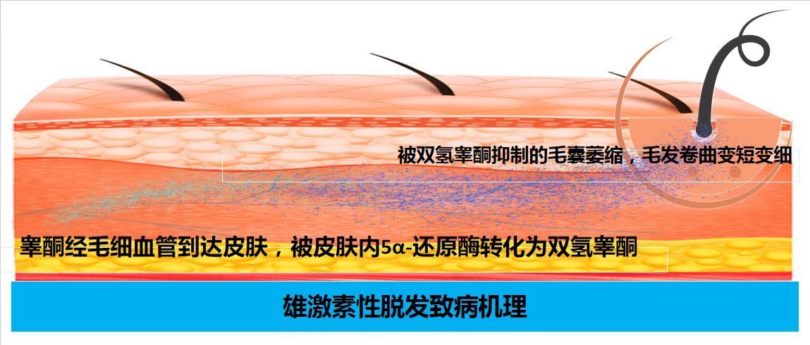 威廉王储同款的“地中海”脱发，有治吗？