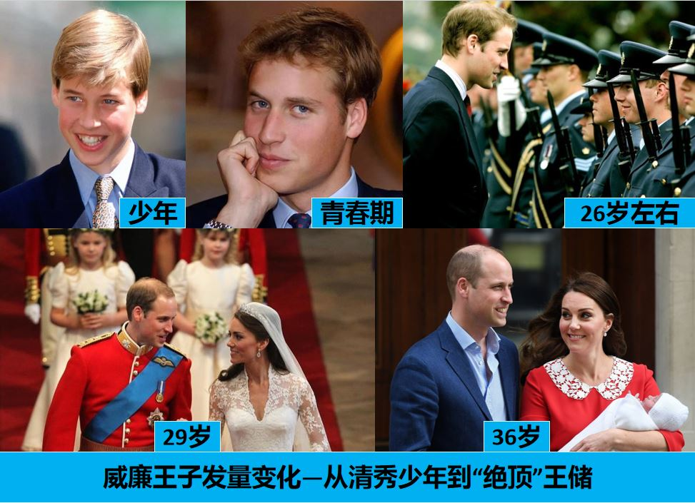 威廉王储同款的“地中海”脱发，有治吗？