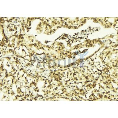 AF0358 c-MYC Antibody - N-terminal IHC Human breast cancer