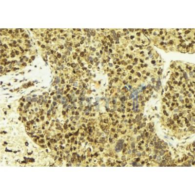 AF6058 Estrogen Receptor-alpha Antibody IHC Human breast cancer