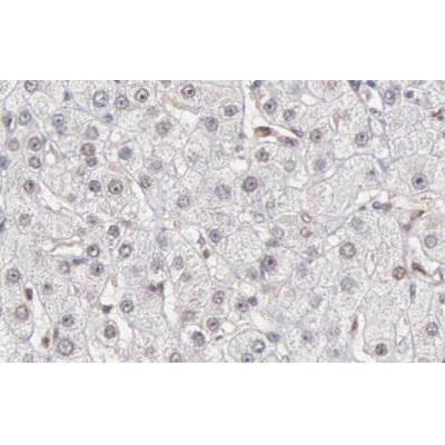 AF0122 Caspase 10 Antibody - C-terminal IHC human liver carcinoma tissue