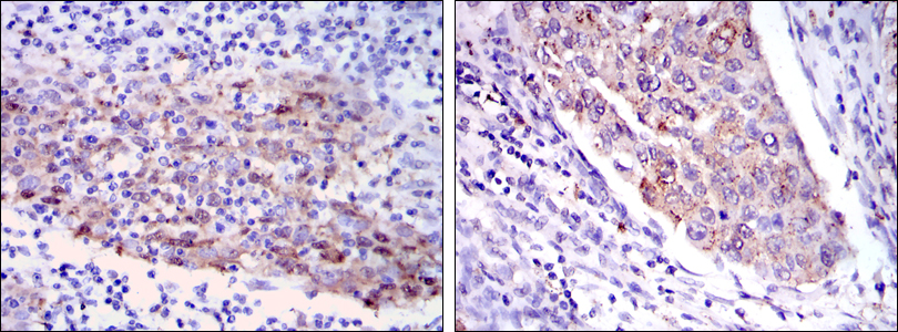 MMP1 Antibody (OAEC04809) in Human cervical cancer tissues (left) and human kidney cancer tissues (right) using Immunohistochemistry