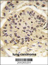 SOX2 Antibody (OAAB07021) in human lung carcinoma tissue using immunohistochemistry
