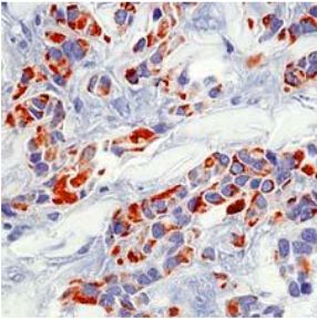 Mouse Anti-KERatIN 18 Monoclonal Antibody (OAAI00270) in Human Breast Cancer using Immunohistochemistry.