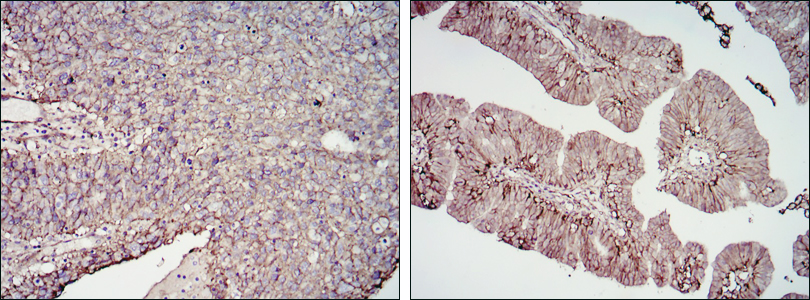 CD276 Antibody (OAEC04678) in Cervical cancer tissues (left) and ovarian cancer tissues (right) using Immunohistochemistry