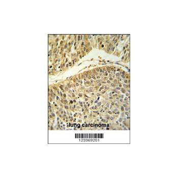 RERE antibody - N-terminal region (OAAB06555) in lung carcinoma using Immunohistochemistry