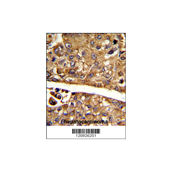MDH1 antibody - C-terminal region (OAAB01681) in human hepatocarcinoma using Immunohistochemistry