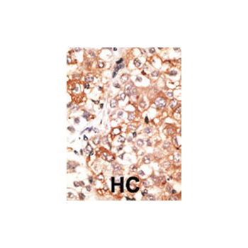 GJA7 antibody - N - terminal region (OAAB11377) in Human cancer using Immunohistochemistry
