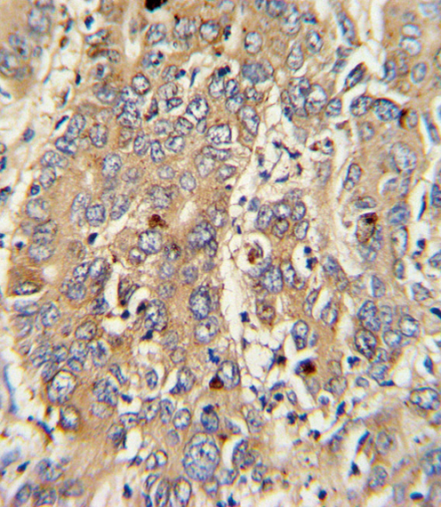 PIGR Antibody (C-term) (OAAB05147) in human hepatocarcinoma tissue using immunohistochemistry