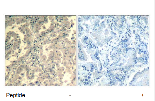 STAT2 Antibody (OASC00366) in human brain carcinoma using Immunohistochemistry
