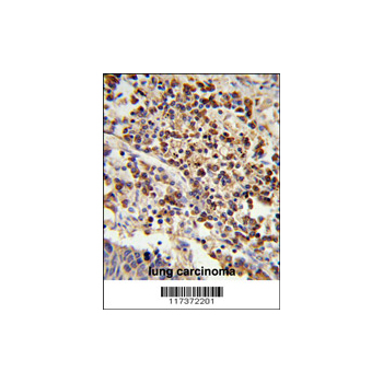 U2AF1 Antibody (OAAB01511) in human lung carcinoma using Immunohistochemistry