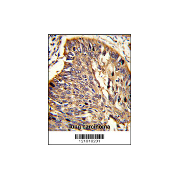 MYD88 antibody - center region (OAAB05114) in human lung carcinoma tissue using Immunohistochemistry