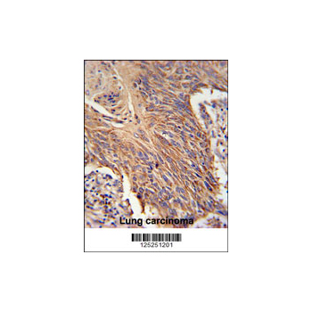 RDH10 antibody - center region (OAAB02157) in lung carcinoma using Immunohistochemistry