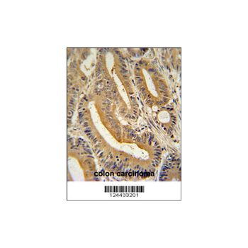 AP3S1 antibody - N-terminal region (OAAB00512) in human colon carcinoma using Immunohistochemistry
