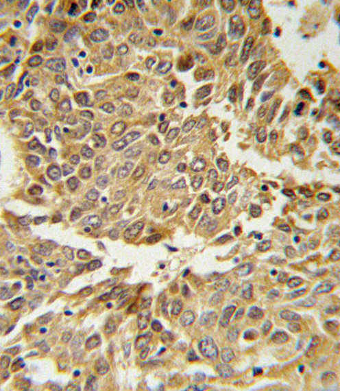 HIF1A Antibody (N-term) (OAAB02194) in lung carcinoma using immunohistochemistry