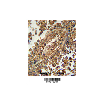 ABCG1 antibody - N-terminal region (OAAB03522) in human lung carcinoma using Immunohistochemistry