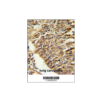 HIF1A antibody - center region (OAAB04807) in lung carcinoma using Immunohistochemistry
