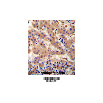 HP antibody - center region (OAAB00697) in human hepatocarcinoma using Immunohistochemistry