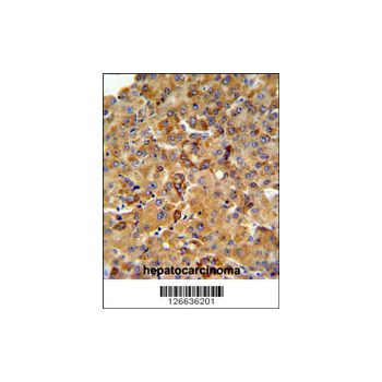 SFT2D3 Antibody (OAAB02685) in human hepatocarcinoma using Immunohistochemistry