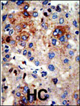HDAC9 Antibody (N-term) (OAAB07338) in human cancer tissue using immunohistochemistry