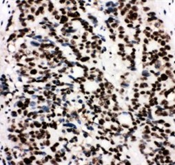 XRCC5 Polyclonal Antibody (OABB00594) in Human Mammary Cancer using Immunohistochemistry