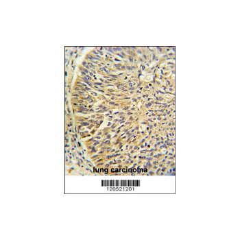 CCT3 antibody - center region (OAAB01653) in human lung carcinoma using Immunohistochemistry