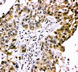 CISH Polyclonal Antibody (OABB00737) in Human Lung Cancer using Immunohistochemistry