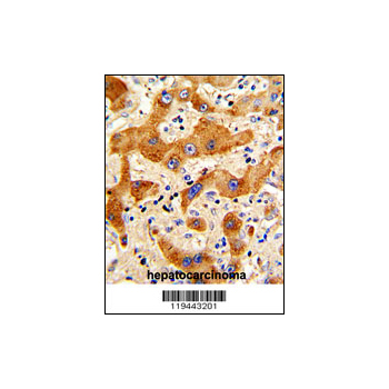 GCG antibody - N-terminal region (OAAB03502) in human hepatocarcinoma using Immunohistochemistry