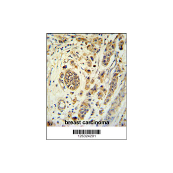 FBXL15 Antibody (OAAB02638) in human brain carcinoma using Immunohistochemistry