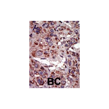 DGKA antibody - C - terminal region (OAAB17490) in Human cancer, breast carcinoma, hepatocarcinoma using Immunohistochemistry